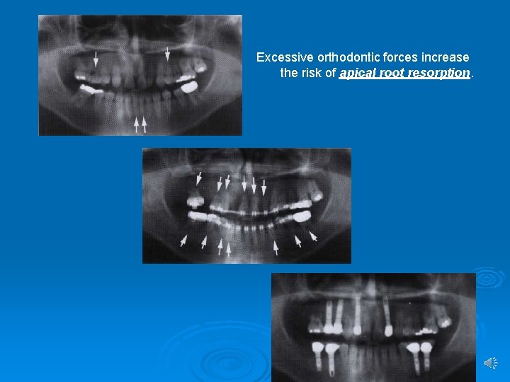 Excessive orthodontic forces increase the risk of apical root resorption. 