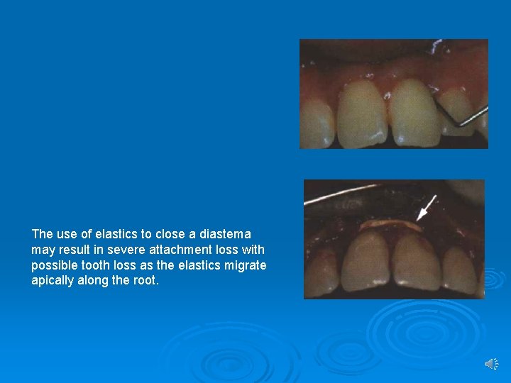 The use of elastics to close a diastema may result in severe attachment loss