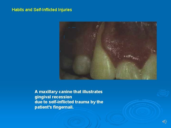 Habits and Self-Inflicted Injuries A maxillary canine that illustrates gingival recession due to self-inflicted