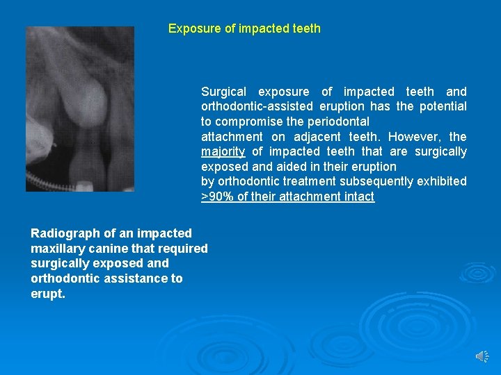 Exposure of impacted teeth Surgical exposure of impacted teeth and orthodontic-assisted eruption has the