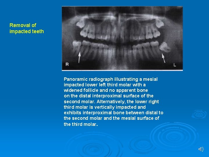 Removal of impacted teeth Panoramic radiograph illustrating a mesial impacted lower left third molar