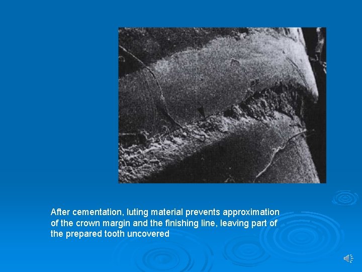 After cementation, luting material prevents approximation of the crown margin and the finishing line,