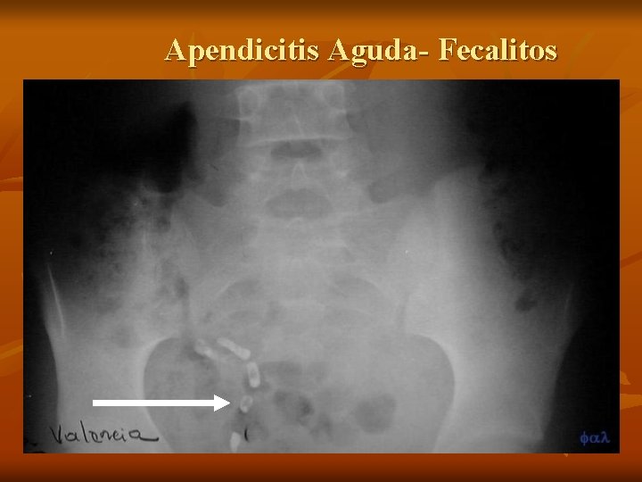 Apendicitis Aguda- Fecalitos Apendicitis Aguda- Fecalitos