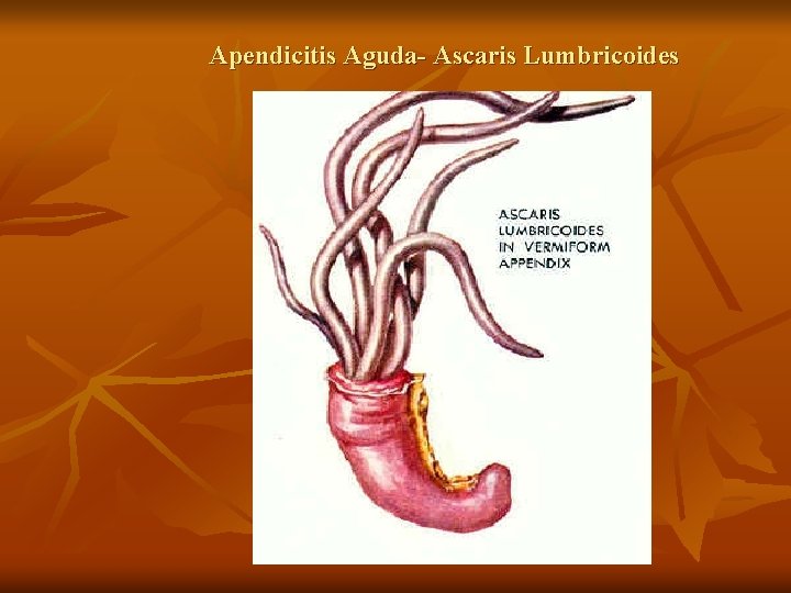 Apendicitis Aguda- Ascaris Lumbricoides 