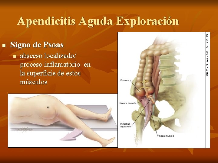 Apendicitis Aguda Exploración n Signo de Psoas n absceso localizado/ proceso inflamatorio en la