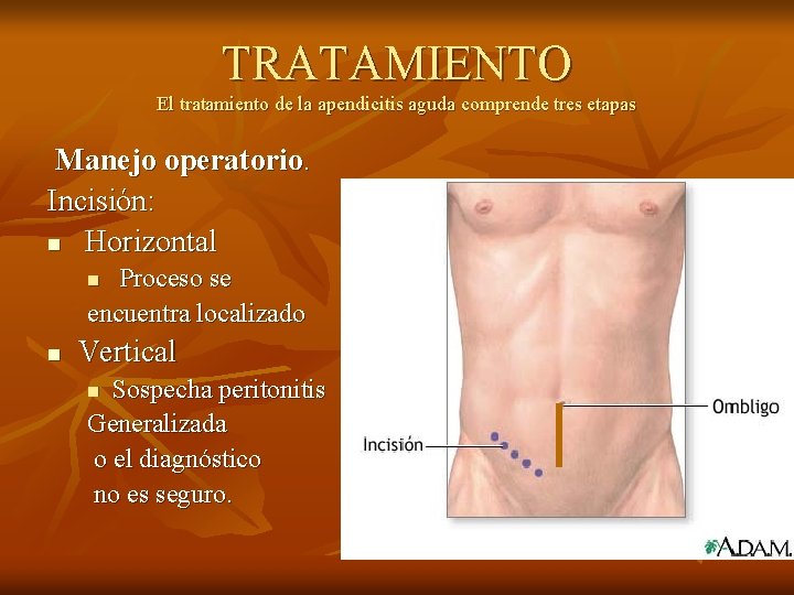 TRATAMIENTO El tratamiento de la apendicitis aguda comprende tres etapas Manejo operatorio. Incisión: n