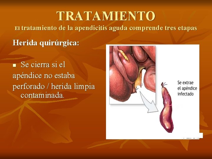 TRATAMIENTO El tratamiento de la apendicitis aguda comprende tres etapas Herida quirúrgica: Se cierra