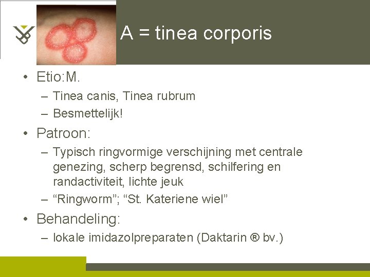 A = tinea corporis • Etio: M. – Tinea canis, Tinea rubrum – Besmettelijk!