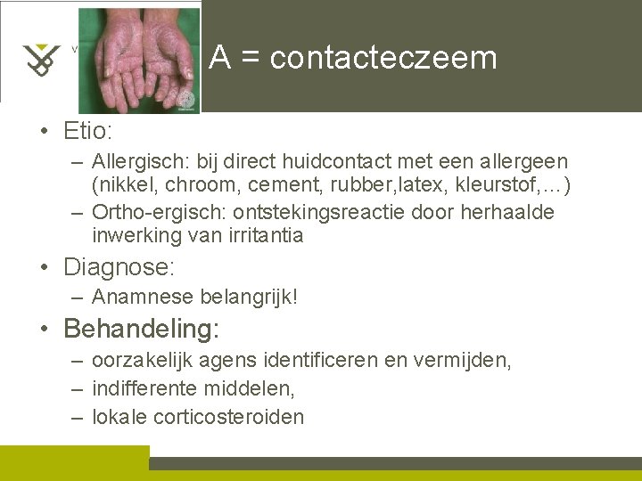 A = contacteczeem • Etio: – Allergisch: bij direct huidcontact met een allergeen (nikkel,