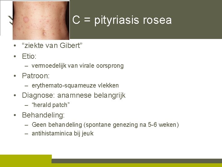 C = pityriasis rosea • “ziekte van Gibert” • Etio: – vermoedelijk van virale