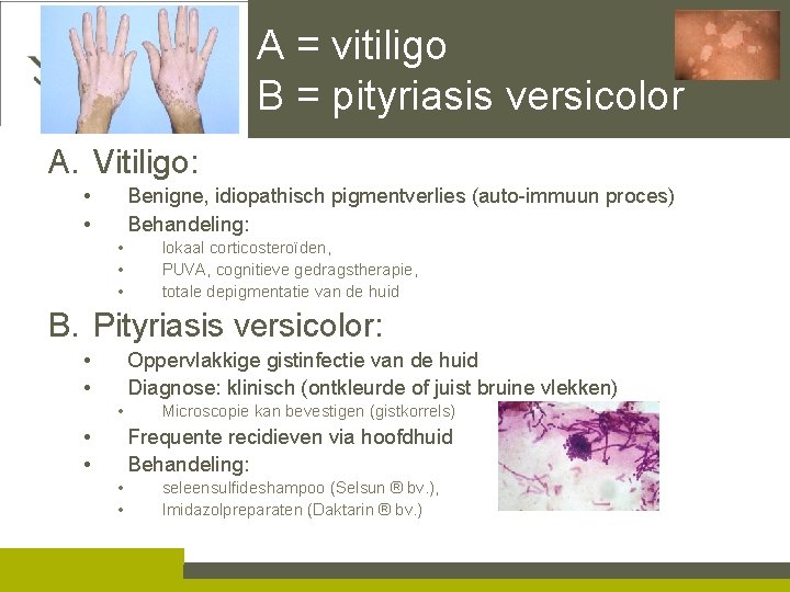 A = vitiligo B = pityriasis versicolor A. Vitiligo: • • Benigne, idiopathisch pigmentverlies