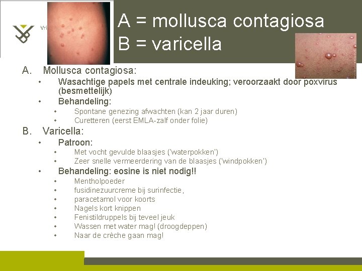 A = mollusca contagiosa B = varicella A. Mollusca contagiosa: • Wasachtige papels met