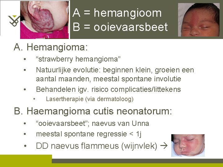 A = hemangioom B = ooievaarsbeet A. Hemangioma: • • “strawberry hemangioma” Natuurlijke evolutie: