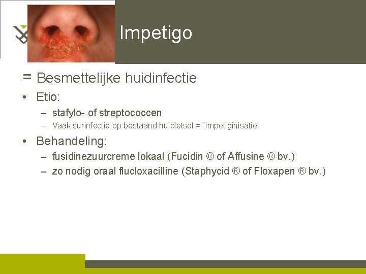 Impetigo = Besmettelijke huidinfectie • Etio: – stafylo- of streptococcen – Vaak surinfectie op