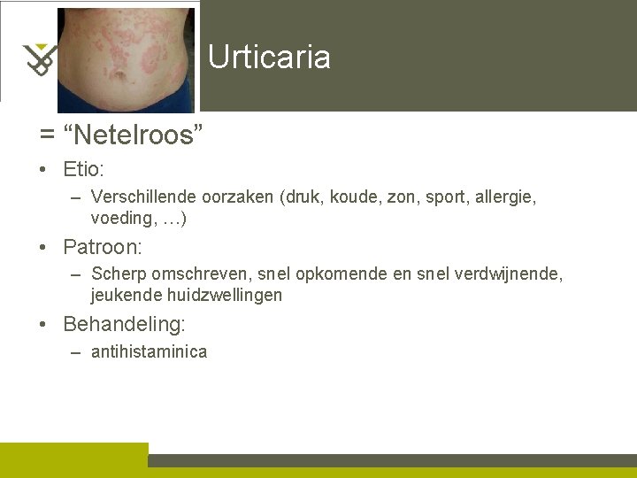Urticaria = “Netelroos” • Etio: – Verschillende oorzaken (druk, koude, zon, sport, allergie, voeding,