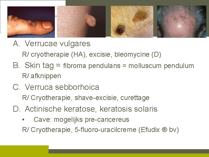 A. Verrucae vulgares R/ cryotherapie (HA), excisie, bleomycine (D) B. Skin tag = fibroma