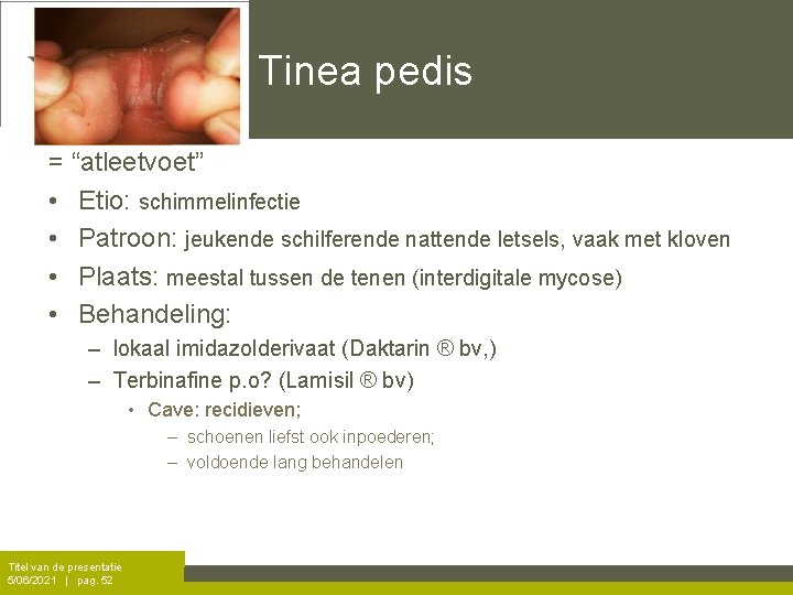 Tinea pedis = “atleetvoet” • Etio: schimmelinfectie • Patroon: jeukende schilferende nattende letsels, vaak