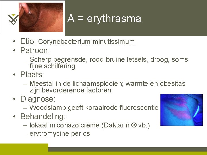 A = erythrasma • Etio: Corynebacterium minutissimum • Patroon: – Scherp begrensde, rood-bruine letsels,