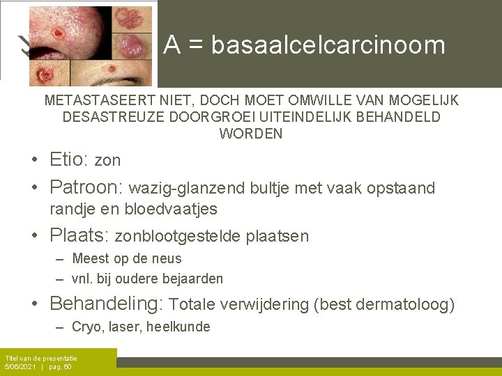 A = basaalcelcarcinoom METASTASEERT NIET, DOCH MOET OMWILLE VAN MOGELIJK DESASTREUZE DOORGROEI UITEINDELIJK BEHANDELD