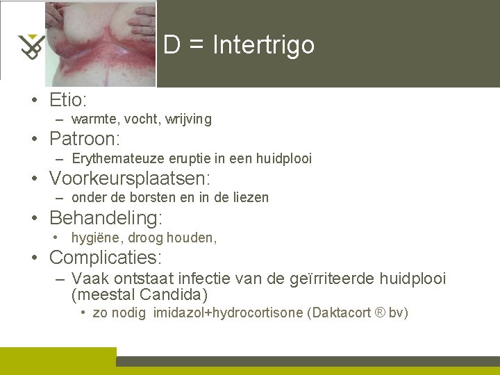 D = Intertrigo • Etio: – warmte, vocht, wrijving • Patroon: – Erythemateuze eruptie