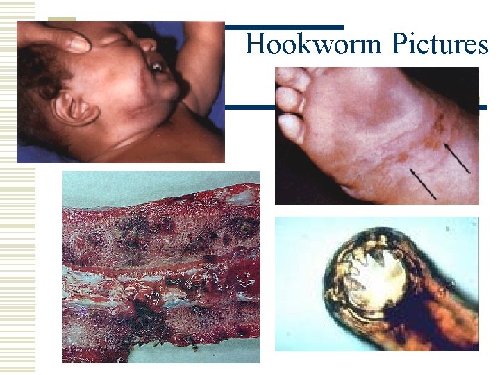 Hookworm Pictures 