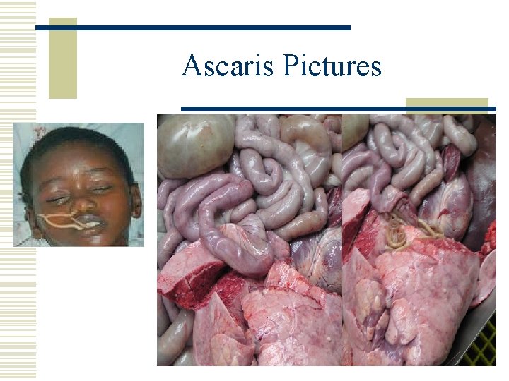 Ascaris Pictures 