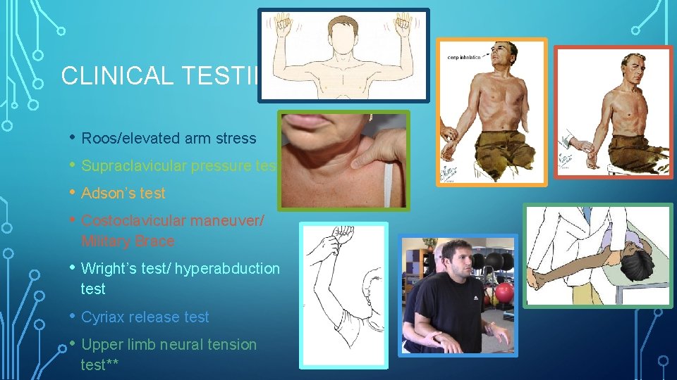 CLINICAL TESTING • Roos/elevated arm stress • Supraclavicular pressure test • Adson’s test •