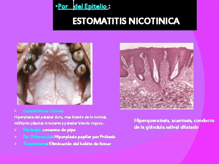  • Por del Epitelio : ESTOMATITIS NICOTINICA Características Clínicas: Hiperplasia del paladar duro,