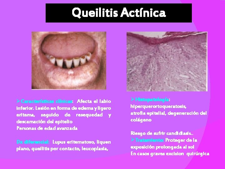 Queilitis Actínica ØCaracterísticas clínicas: Afecta el labio inferior. Lesión en forma de edema y