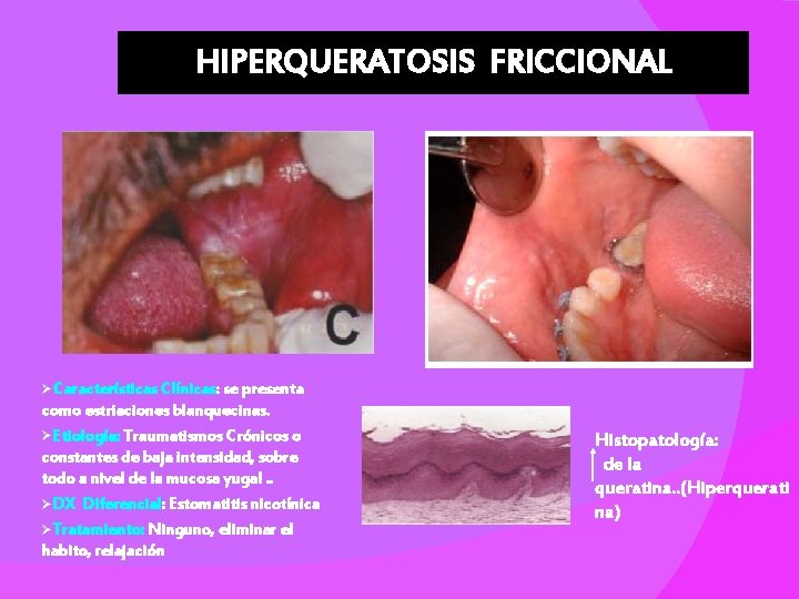 HIPERQUERATOSIS FRICCIONAL ØCaracterísticas Clínicas: se presenta como estriaciones blanquecinas. ØEtiología: Traumatismos Crónicos o constantes