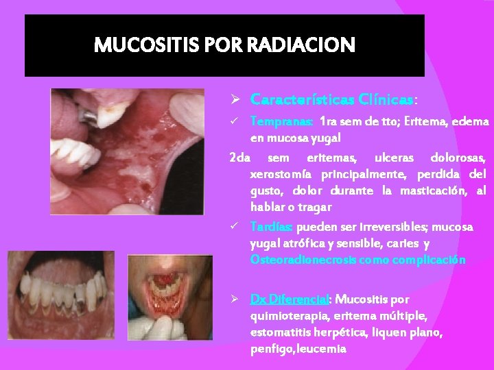 MUCOSITIS POR RADIACION Ø Características Clínicas: Tempranas: 1 ra sem de tto; Eritema, edema