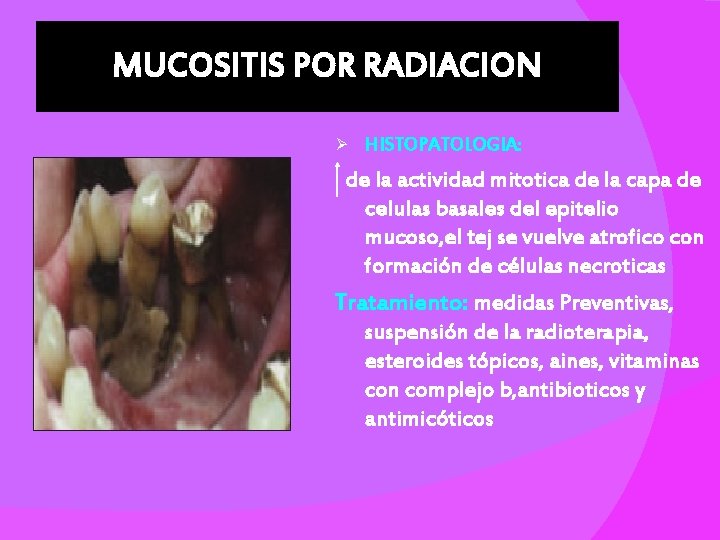 MUCOSITIS POR RADIACION Ø HISTOPATOLOGIA: de la actividad mitotica de la capa de celulas