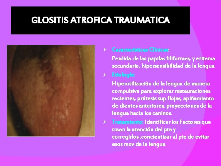 GLOSITIS ATROFICA TRAUMATICA Características Clínicas: Perdida de las papilas filiformes, y eritema secundario, hipersensibilidad