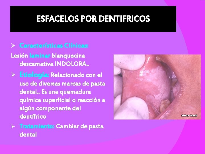 ESFACELOS POR DENTIFRICOS Ø Características Clínicas: Lesión laminar blanquecina descamativa INDOLORA. . Ø Etiología: