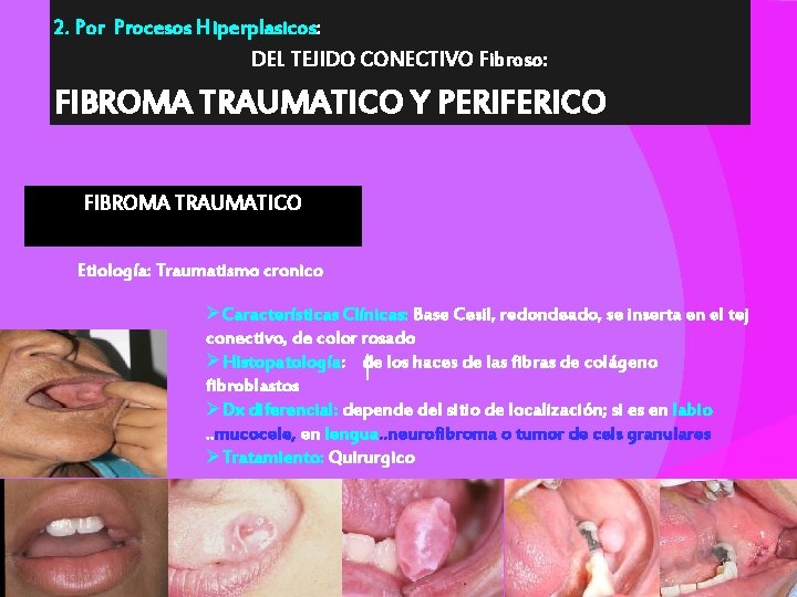 2. Por Procesos Hiperplasicos: DEL TEJIDO CONECTIVO Fibroso: FIBROMA TRAUMATICO Y PERIFERICO FIBROMA TRAUMATICO
