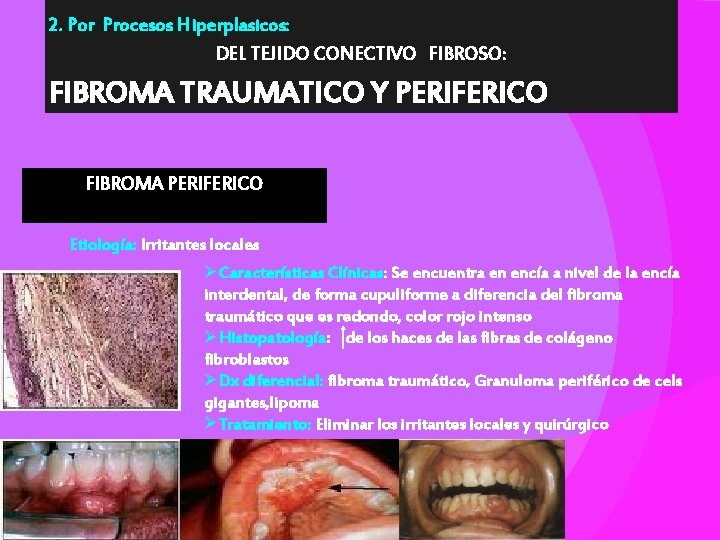 2. Por Procesos Hiperplasicos: DEL TEJIDO CONECTIVO FIBROSO: FIBROMA TRAUMATICO Y PERIFERICO FIBROMA PERIFERICO