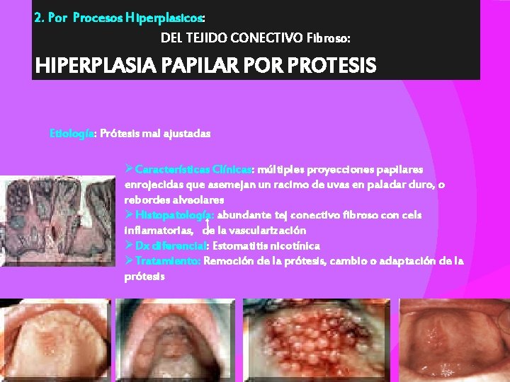 2. Por Procesos Hiperplasicos: DEL TEJIDO CONECTIVO Fibroso: HIPERPLASIA PAPILAR POR PROTESIS Etiología: Prótesis