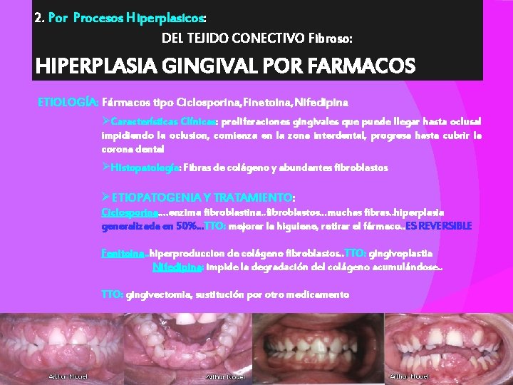 2. Por Procesos Hiperplasicos: DEL TEJIDO CONECTIVO Fibroso: HIPERPLASIA GINGIVAL POR FARMACOS ETIOLOGÍA: Fármacos
