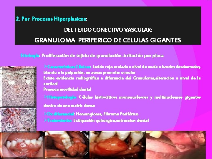 2. Por Procesos Hiperplasicos: DEL TEJIDO CONECTIVO VASCULAR: GRANULOMA PERIFERICO DE CELULAS GIGANTES Etiología: