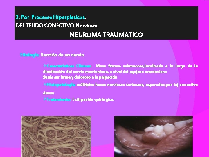 2. Por Procesos Hiperplasicos: DEL TEJIDO CONECTIVO Nervioso: NEUROMA TRAUMATICO Etiología: Sección de un