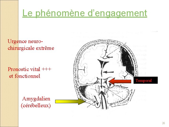 Le phénomène d’engagement Urgence neurochirurgicale extrême Pronostic vital +++ et fonctionnel Temporal Amygdalien (cérébelleux)