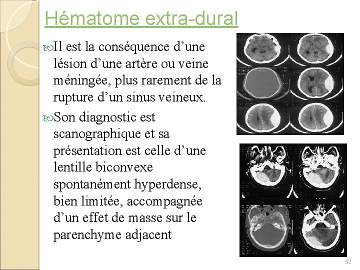 Hématome extra-dural Il est la conséquence d’une lésion d’une artère ou veine méningée, plus