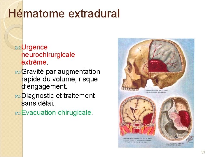 Hématome extradural Urgence neurochirurgicale extrême Gravité par augmentation rapide du volume, risque d’engagement. Diagnostic