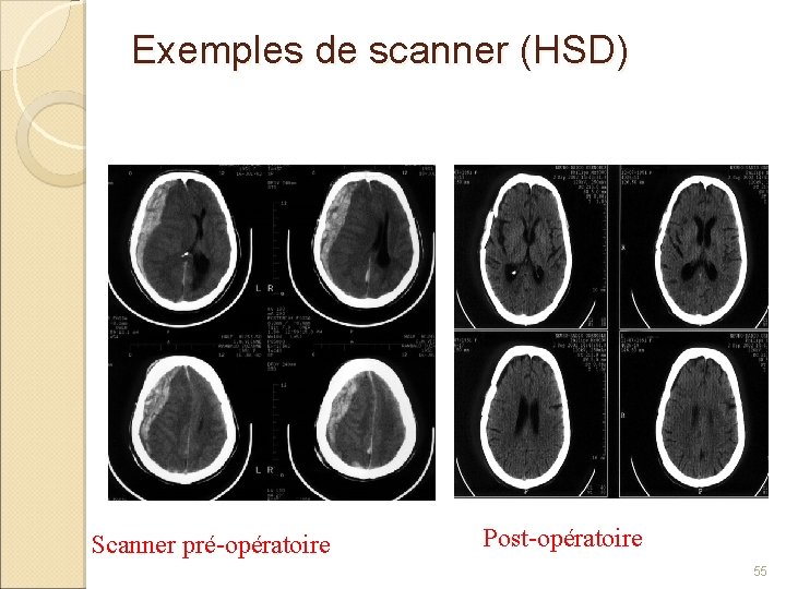 Exemples de scanner (HSD) Scanner pré-opératoire Post-opératoire 55 