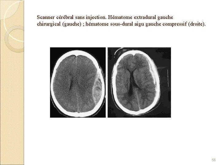 Scanner cérébral sans injection. Hématome extradural gauche chirurgical (gauche) ; hématome sous-dural aigu gauche