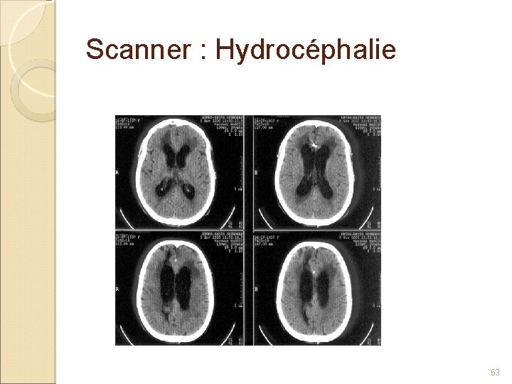 Scanner : Hydrocéphalie 63 