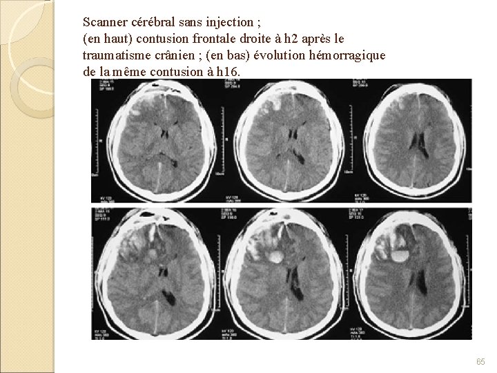 Scanner cérébral sans injection ; (en haut) contusion frontale droite à h 2 après