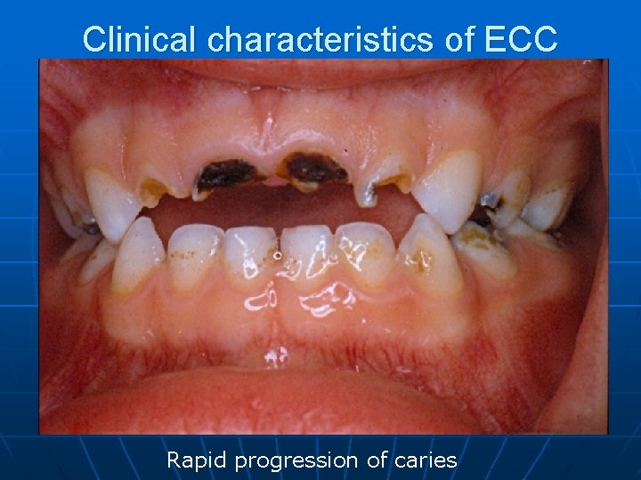 Clinical characteristics of ECC Rapid progression of caries 