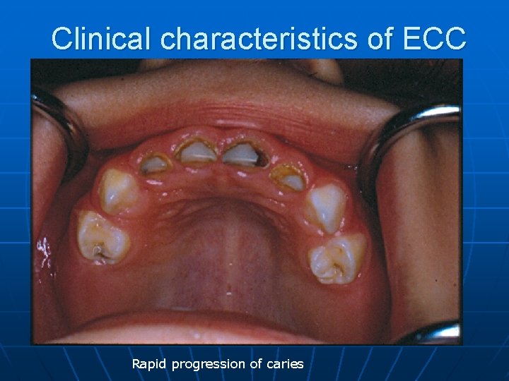 Clinical characteristics of ECC Rapid progression of caries 
