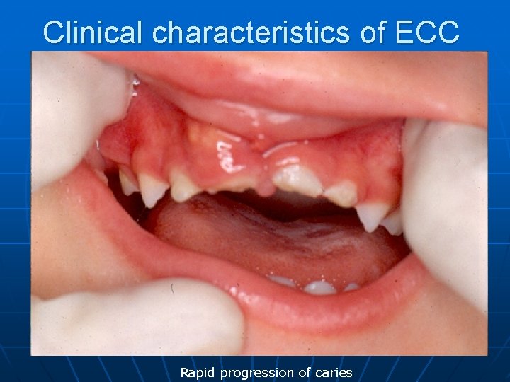 Clinical characteristics of ECC Rapid progression of caries 